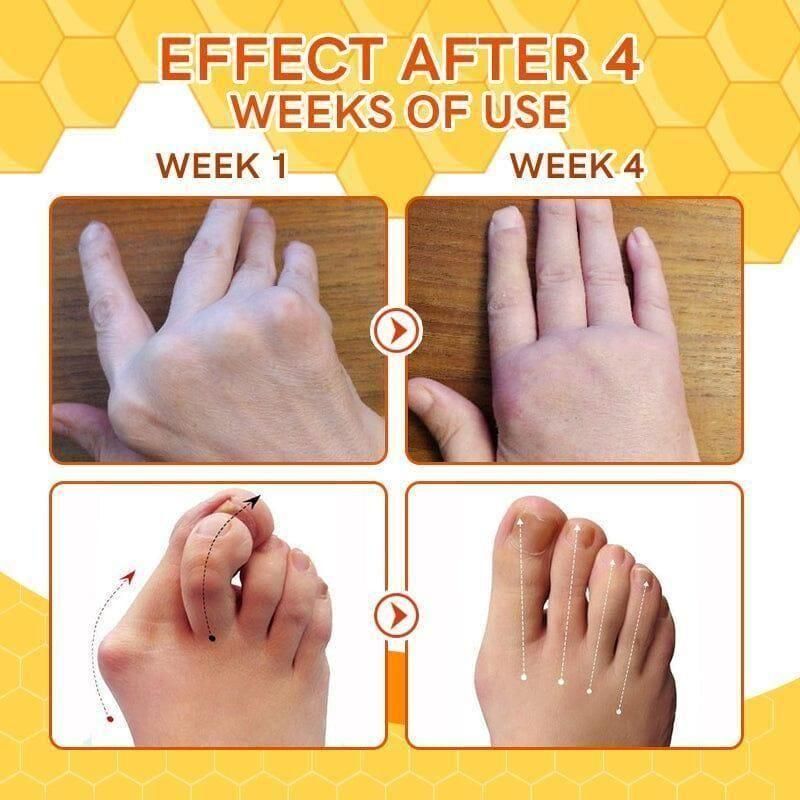 Bee Venom Spider Veins Spray before after