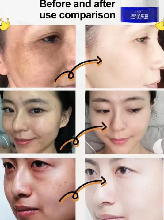 Vitamin E Urea Cream before after