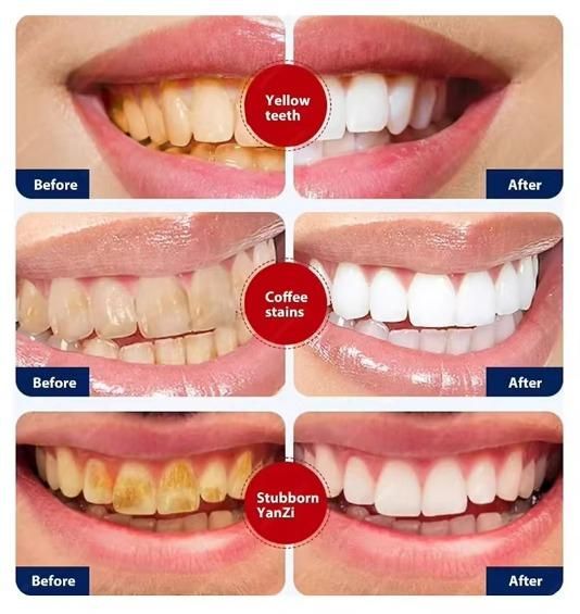 Smoke Stains White Plus Toothpaste before after 2