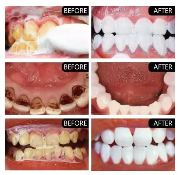 Smoke Stains White Plus Toothpaste before after