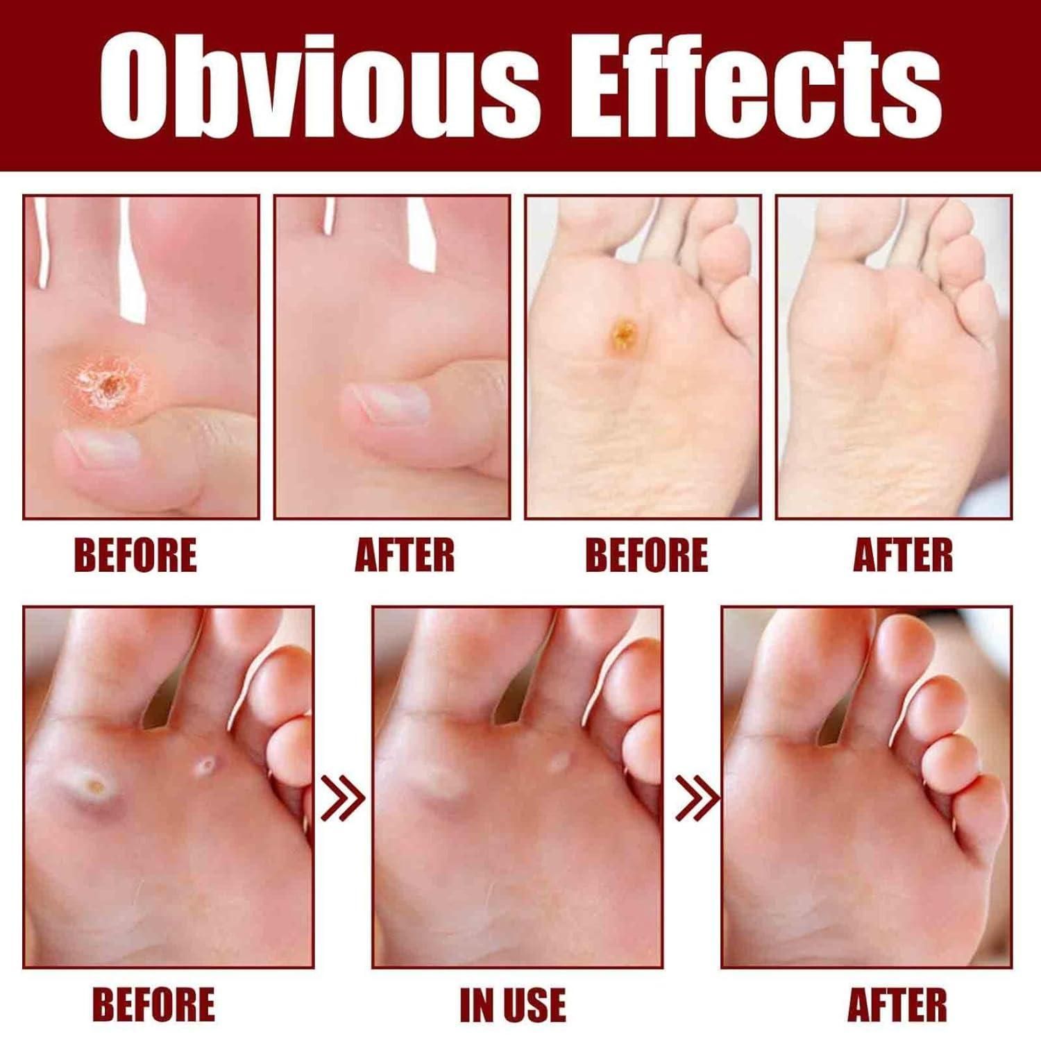 Feet Corn Removal Serum after before